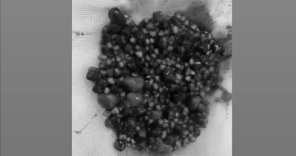 552 TAŞ SAFRA KESESİNDEN ÇIKTI